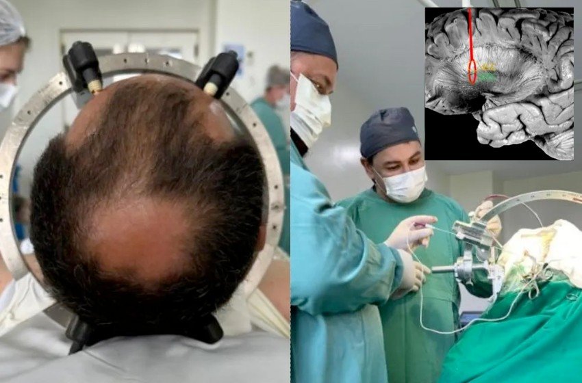 Microchip cerebral para tratamento de TOC é inserido pela 1ª vez em SC